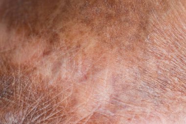 Kurutulmuş ve çatlamış insan derisi dokusunun yakın çekimi