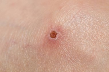 İyileşme sürecinde insan derisindeki kuru bir yaranın yakın görüntüsü doğal deri dokusunu ve iyileşme aşamasını gösteriyor..