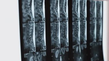 Sağlık analizleri, röntgen taramaları, omurga ayrıntıları. Omurga röntgenleri yakın çekim sırasında omurların hizalanması, tıbbi teşhis ve sağlık değerlendirmesi için gereklidir..