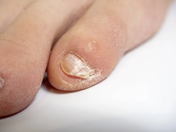 Close Van Tenen Met Nagelproblemen Infectie Scheuren Onbehoorlijke Verzorging Nagelverzorging — Stockfoto