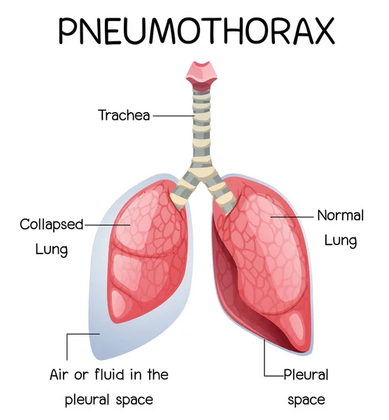 Pneumothorax Kreskówki Anatomii Człowieka Ilustracji — Wektor stockowy