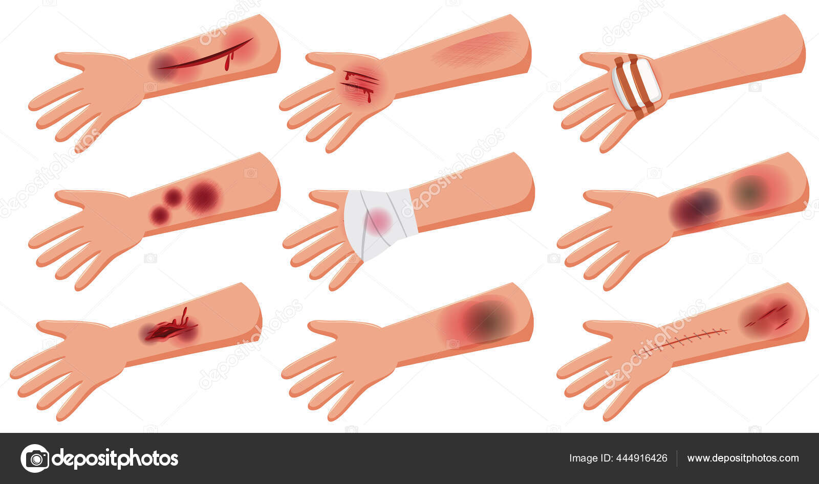 Group Lesion Arm Skin Injury Accident Cartoon Style Illustration Stock Vector Image by ©brgfx #444916426 Group Lesion Arm Skin Injury Accident Cartoon Style Illustration Stock Vector Image by ©brgfx #444916426