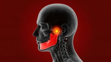 Kırmızı ve turuncu ile işaretlenmiş çene ve temporomandibular eklemli, koyu kırmızı arkaplan üzerine kurulmuş bir insan kafasının detaylı üç boyutlu görüntüsü. Bu tıbbi illüstrasyon çene bölgesindeki rahatsızlığı betimler.