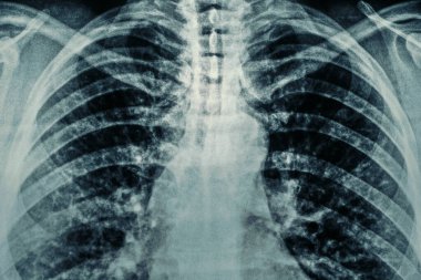 Radyolojik göğüs röntgeni filminin film tanecikli makro fotoğrafı. Astım, COVID-19, koronavirüs veya zatürree tanı konsepti