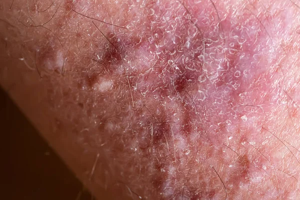Líquen plano na pele da perna close-up. Doença dermatológica em forma de manchas vermelhas, erupções cutâneas e comichão na superfície da pele — Fotografia de Stock