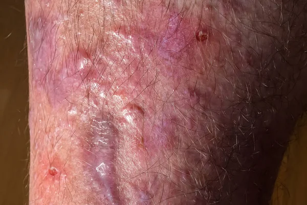 Spots of lichen planus on a male leg. Dermatological immune diseases — Stock Photo, Image