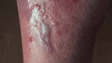 Erkek bacağında benekler var. Dermatolojik bağışıklık hastalıkları