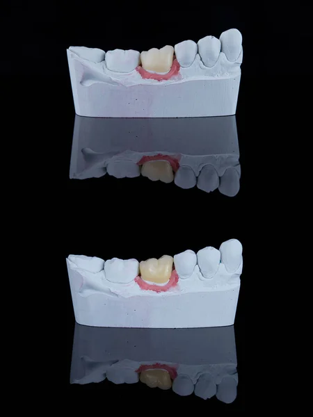 Cerrar corona dental artificial antes y después de pintar. Corona dental molar sobre modelo de yeso. — Foto de Stock