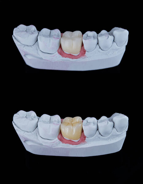 Close up artificial dental crown before and after painting. Molar dental crown on gypsum model.