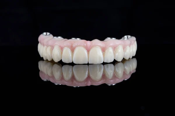 Kwaliteit tandprothese gemaakt van titanium balk en keramiek voor bevestiging aan de bovenkaak. Tandbehandeling. — Stockfoto