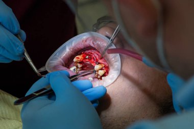 Üst çeneye dört diş implantı yerleştirmek için ameliyat. Diş bakımı ve tedavi. Diş sorunları.