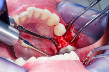 Diş etlerinin cerrahi bir kesikten sonra diş implantasyonundan önce neşterle çene kemiği açılmış.