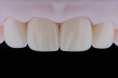 Yüksek kalite, doğal olarak üst çenenin ön dişlerine takmak için seramikten yapılmış dört diş kaplaması. Diş tedavisi. Siyah arkaplan.