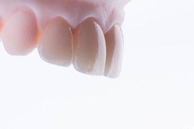 Yüksek kalite, doğal olarak üst çenenin ön dişlerine takmak için seramikten yapılmış dört diş kaplaması. Diş tedavisi. Beyaz arkaplan.