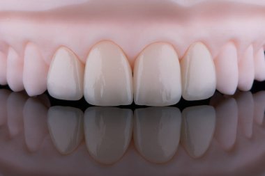 Yüksek kalite, doğal olarak üst çenenin ön dişlerine takmak için seramikten yapılmış dört diş kaplaması. Diş tedavisi. Siyah arkaplan.