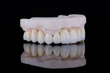 Üst çeneye sabitleme için zirkonyumdan yapılmış yüksek kaliteli tam kemerli diş köprüsü..