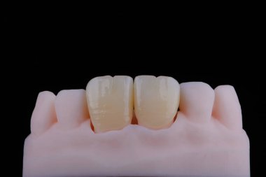 Yüksek kalite doğal olarak zirkonyumdan yapılmış üç diş kaplaması üst çenenin ön dişlerini sabitlemek için. Diş tedavisi.