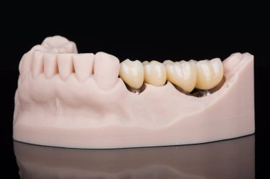 Alt çenenin Buccal bölgesindeki implantlara takılan üç titanyum aptlarında zirkonyumdan yapılmış diş köprüsü. Diş tedavisi ve implantasyon.