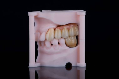 Üç dişli diş köprüsü ve implantların sabitlenmesi için monolitik zirkondan yapılmış yapay sakız. Bir tane de alt çenede. Yazdırılmış modeller üzerindeki yapay dişler.