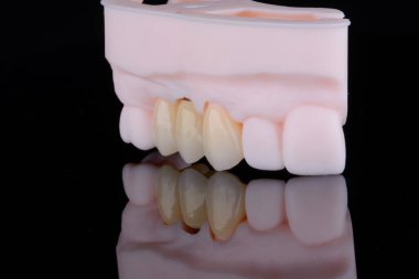 Zirkonyumdan yapılmış dişler üst çeneye sabitlenmek için bunlardan biri titanyum ayağında. Diş tedavisi.