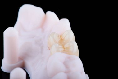 Yüksek kalite, doğal olarak üst çenenin dişlerini sabitlemek için çok katmanlı zirkonyumdan yapılmış üç diş kaplaması..