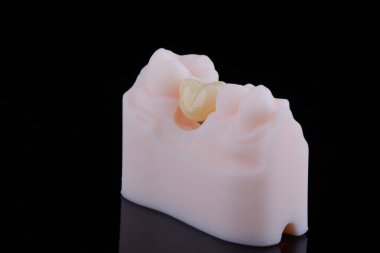 Alt çeneye yerleştirmek için titanyum ayaklara takılan zirkonyumdan yapılmış iki diş kaplaması. Diş tedavisi ve implantasyon.