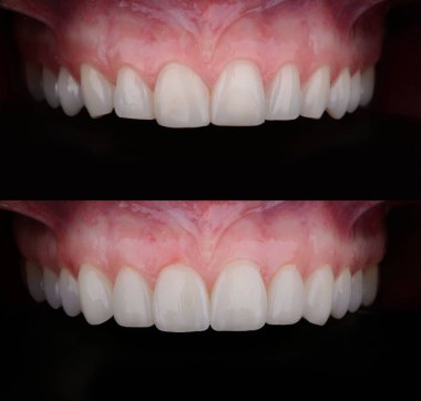Diş kaplamalarından önce ve sonra protez düzeltmeyi gösteren altı adet seramik ultra ince kaplama.