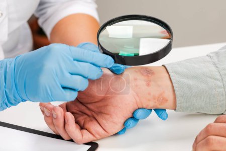 Un dermatólogo que usa guantes examina la piel de un paciente enfermo. Examen y diagnóstico de enfermedades de la piel-alergias, psoriasis, eczema, dermatitis.