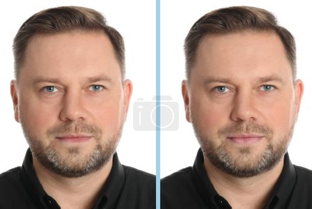 Collage con fotos del hombre antes y después del aumento de labios Collage con fotos del hombre antes y después del aumento de labios