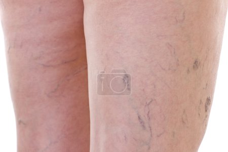 Primer plano de piernas con venas varicosas
