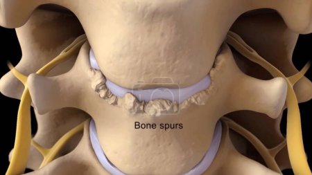 Spinal Stenosis as a degenerative illness in the human vertebrae causing compressed spine nerves medical concept as a 3D illustration.