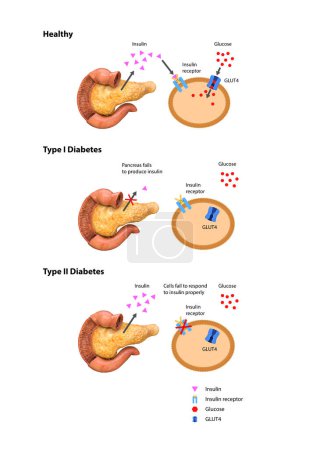 Acción insulínica y diabetes tipo 1 y 2, gráfico 2d 3d, renderizado, ilustración