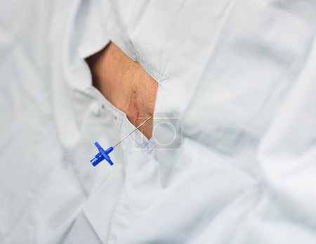 Photo for Epidural analgesia - Royalty Free Image