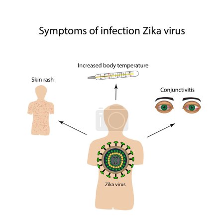 Virus Zika. Síntomas de infección. Infografías. Ilustración vectorial
