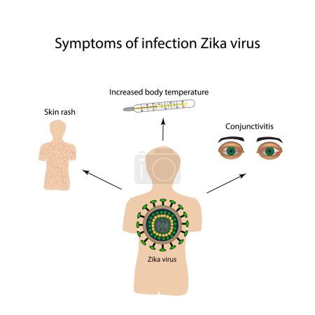 Téléchargez les illustrations : Virus Zika. Symptômes de l'infection. Infographie. Illustration vectorielle
. - en licence libre de droit