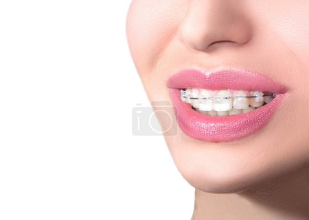 Frenos cerámicos de primer plano en los dientes. Hermosa sonrisa femenina con tirantes. Tratamiento ortodóncico. Concepto de cuidado dental. 