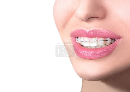 Foto de Frenos cerámicos de primer plano en los dientes. Hermosa sonrisa femenina con tirantes. Tratamiento ortodóncico. Concepto de cuidado dental. - Imagen libre de derechos