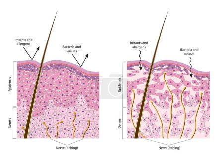 Normal and dry skin. Diagram