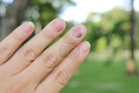 Photo for Fungus Infection on Nails Hand, Finger with onychomycosis. - Royalty Free Image